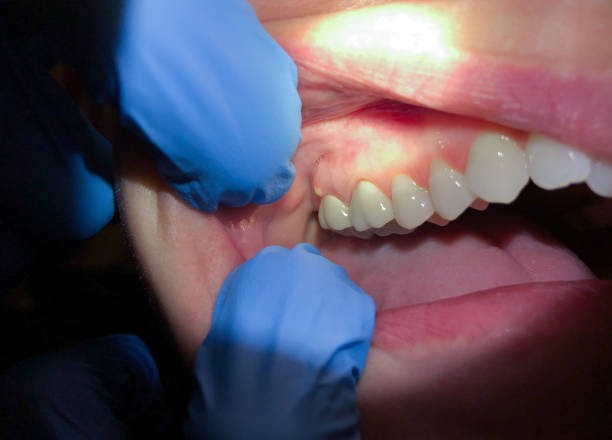 Best Emergency Root Canal Treatment in Shelby, NC